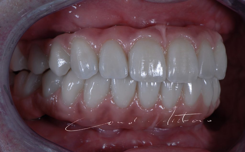 Details on occlusion of oral rehabilitation